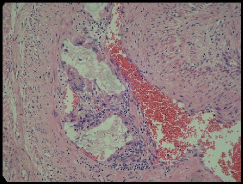 Polivinil alcohol en arterias uterinas - <div style=